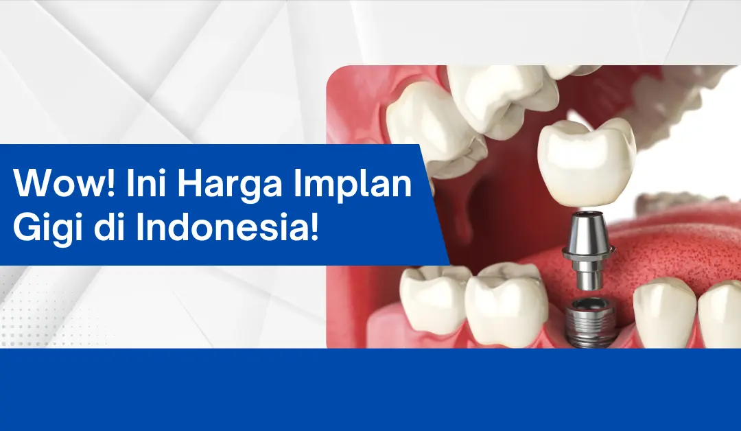 Wow! Ini Harga Implan Gigi di Indonesia!