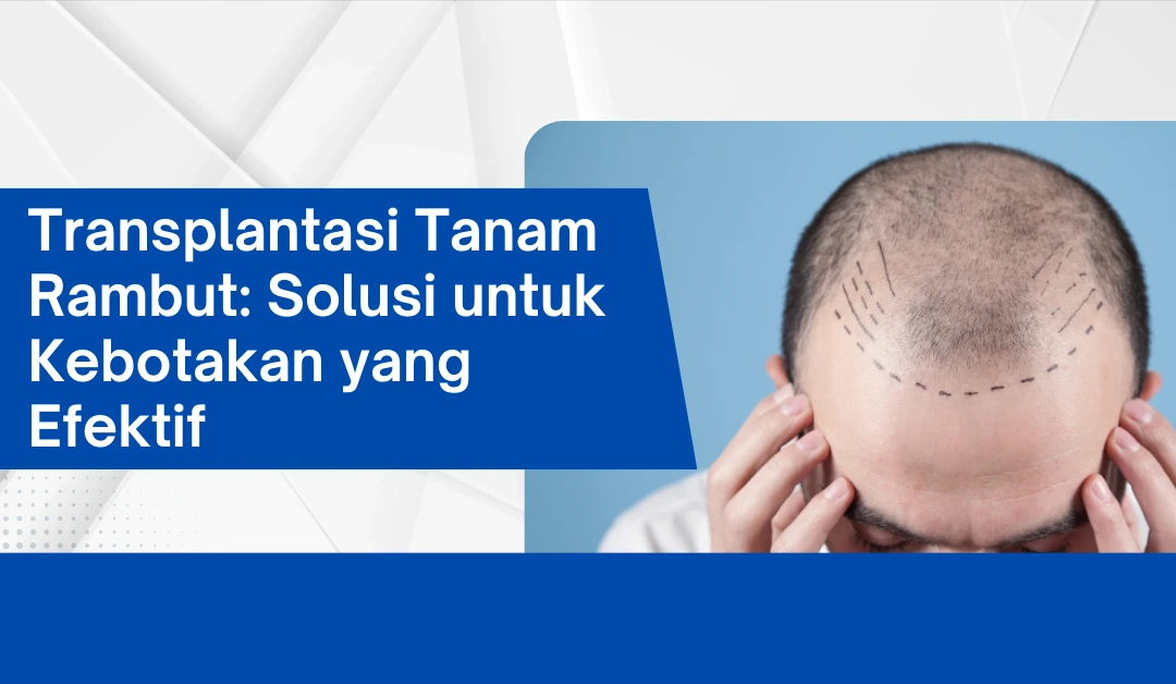 transplantasi-tanam-rambut:-solusi-untuk-kebotakan-yang-efektif